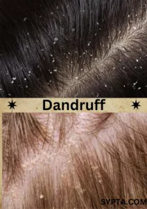 Dandruff treatment at home 