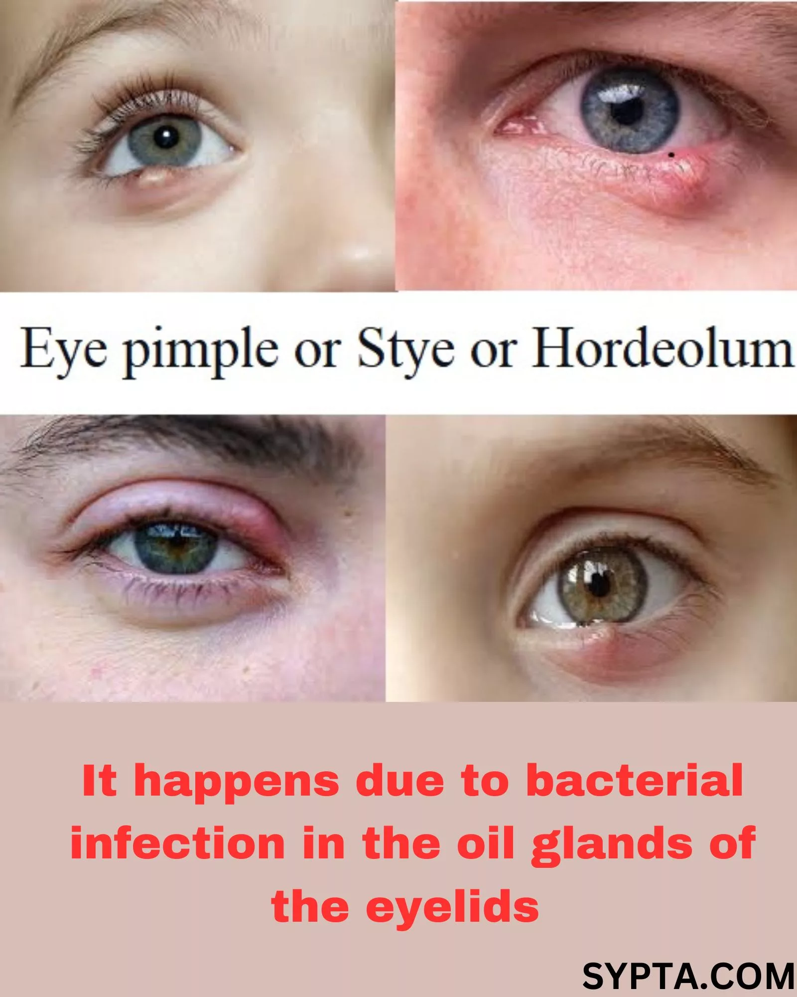 Eye pimple home remedies