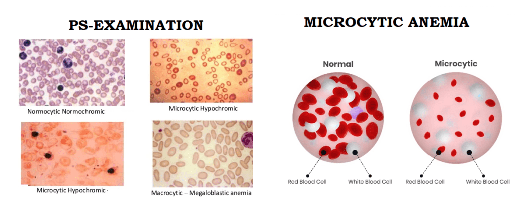 MICROCYTIC HYPOCHROMIC ANEMIA